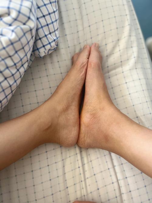 痛风20多天了还没好