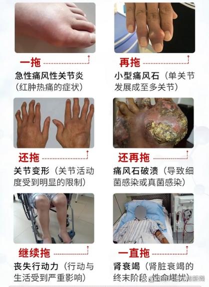 西南医院治疗痛风案例