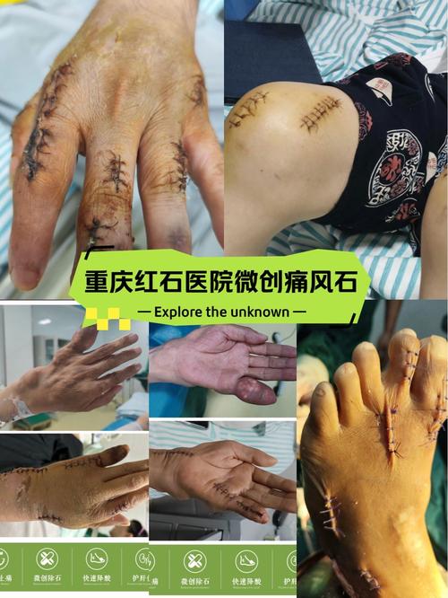 太原那家医院治疗痛风