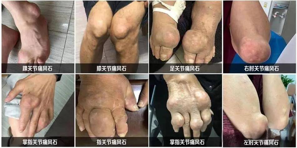 27岁痛风尿酸500