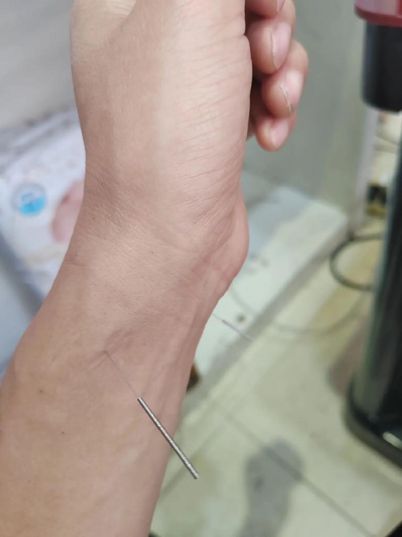 双向情感障碍能针灸吗