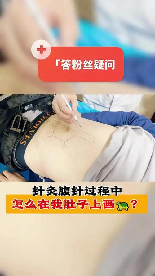 排卵后可以针灸肚子吗