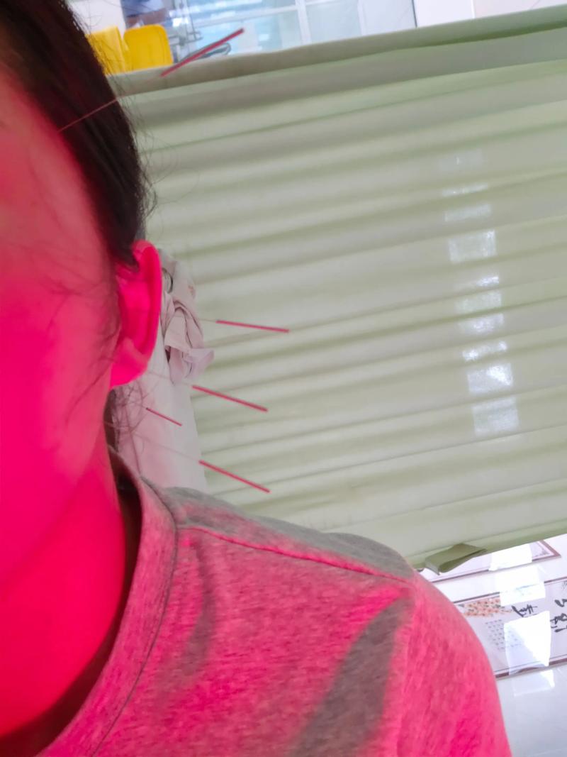 针灸治疗颞颌关节紊乱