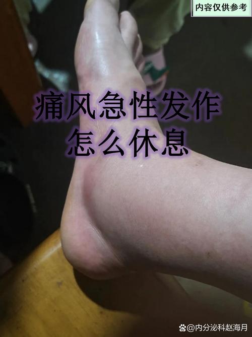 痛风急性发作周期多长