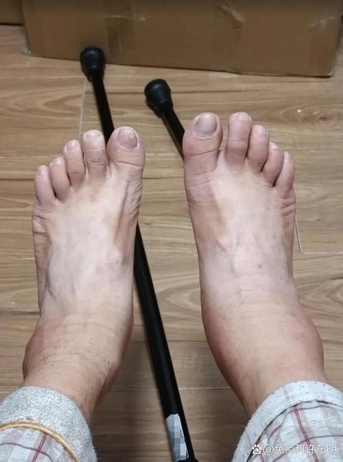 尿酸700多是痛风吗