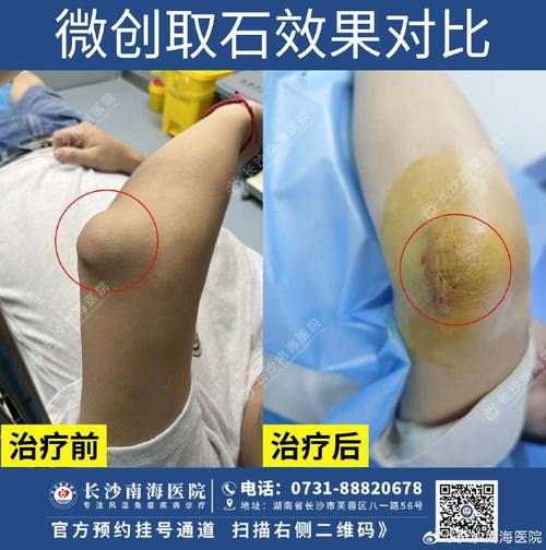 长沙哪家医院治疗痛风