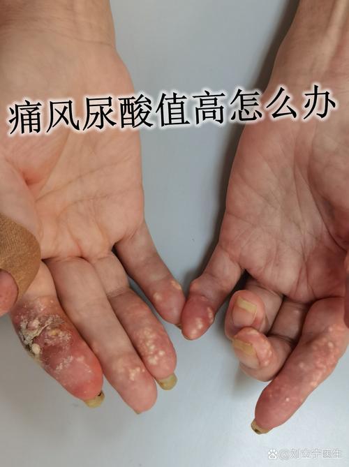 快速c反应蛋白 痛风