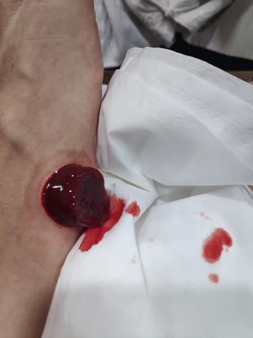 痛风自己在家放血治疗