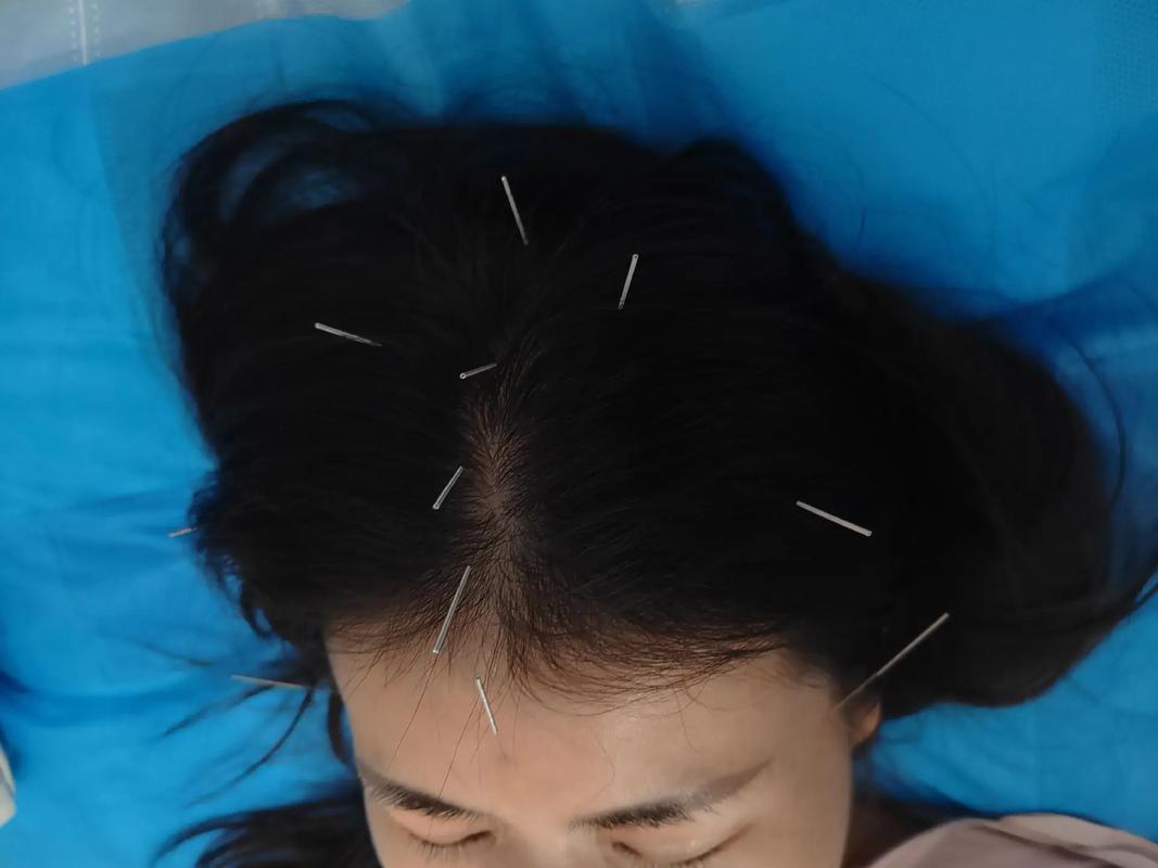 针灸头部后可以洗头吗