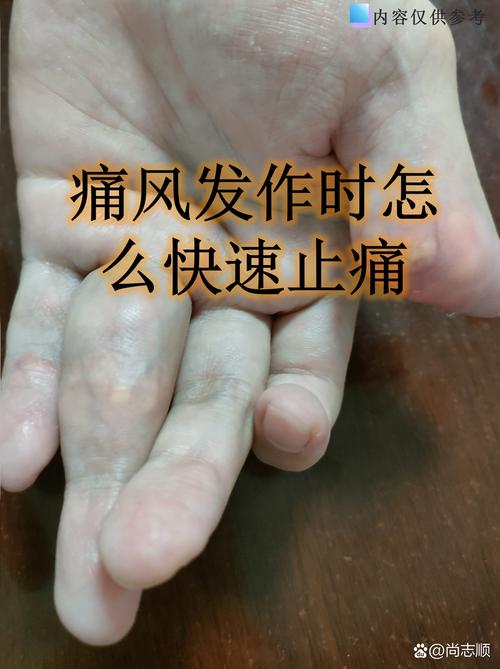 上海怎样快速治疗痛风