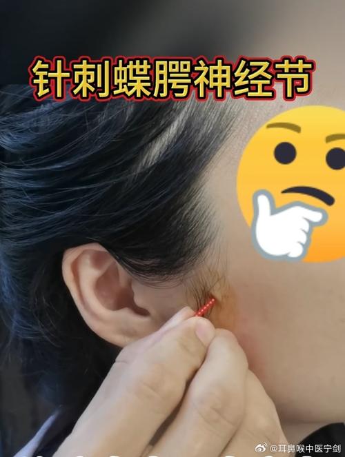 颞下颌关节紊乱针灸哪