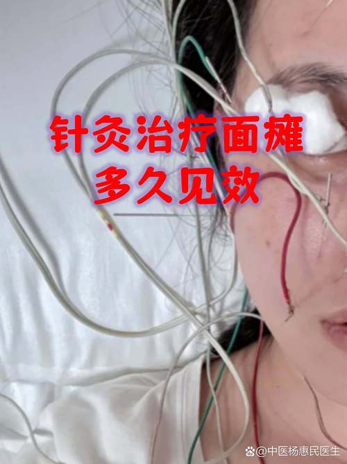 面瘫什么时候不用针灸