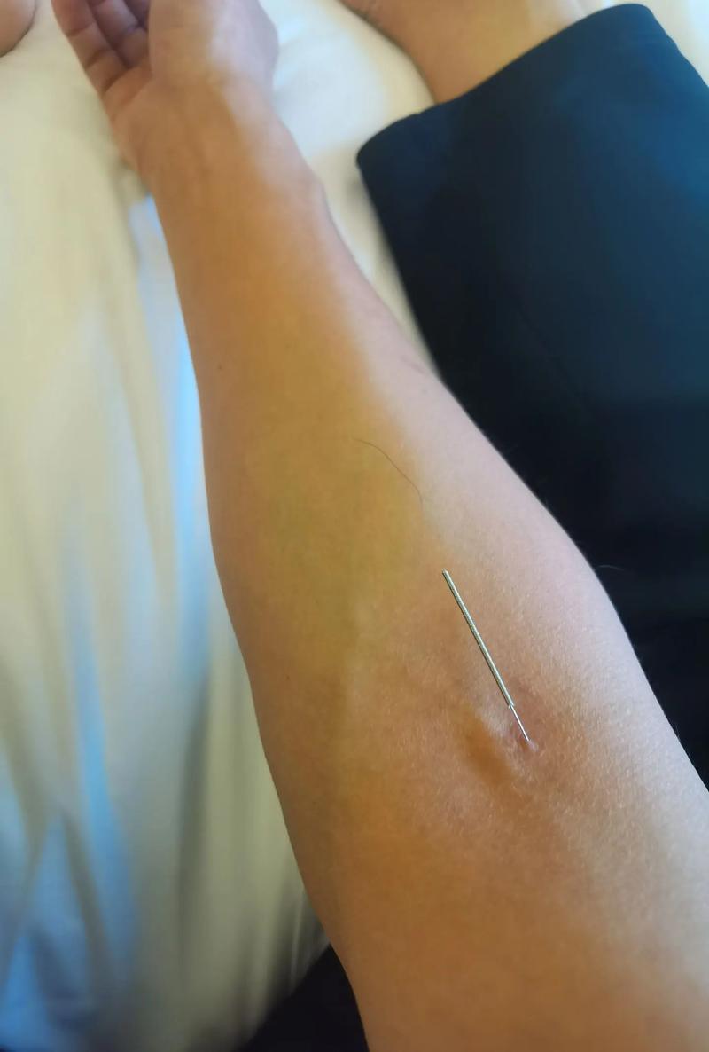 孕晚期咳嗽可以针灸吗