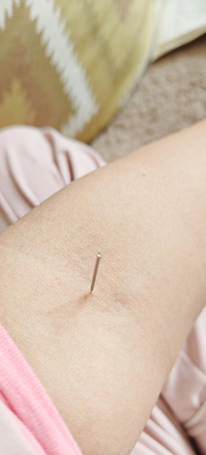 孕晚期咳嗽可以针灸吗