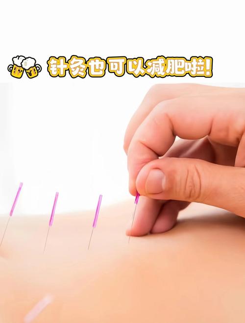 中医针灸减肥效果好吗