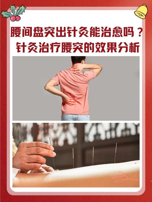 腰疼针灸需要几个疗程