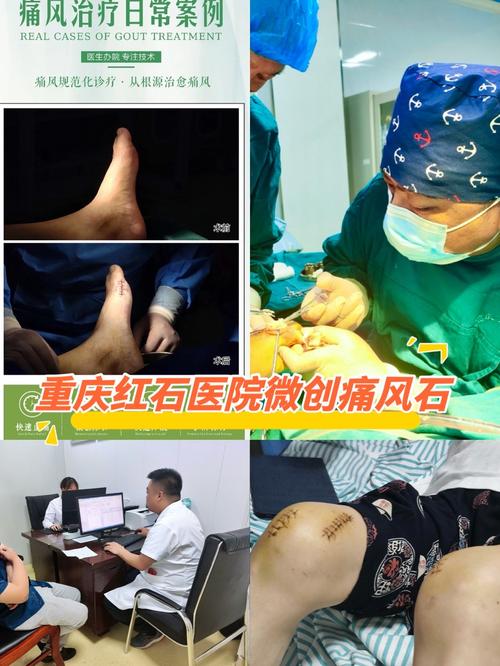 沈阳什么医院治疗痛风