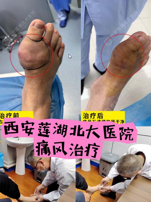 西安治疗痛风最好医院