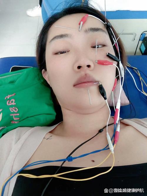 轻度面瘫需要针灸几天