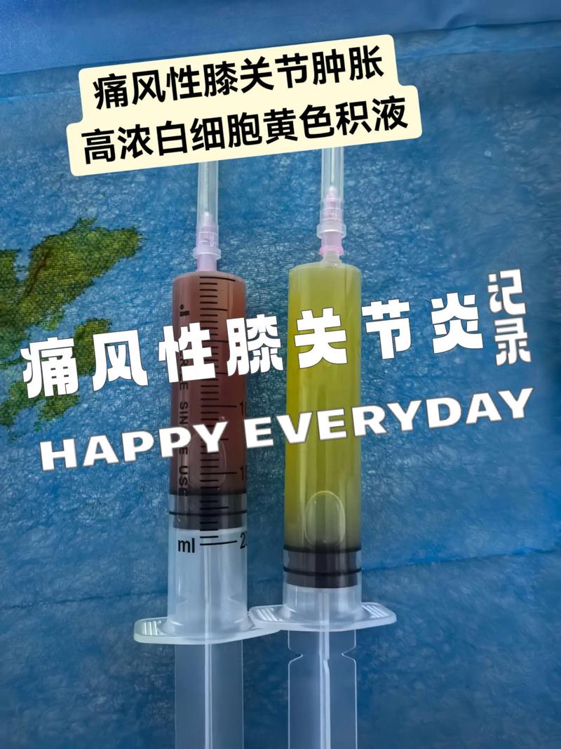 痛风膝盖肿大怎么消肿