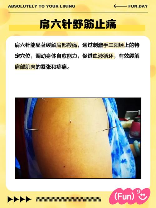 针灸治疗肩周炎的优势