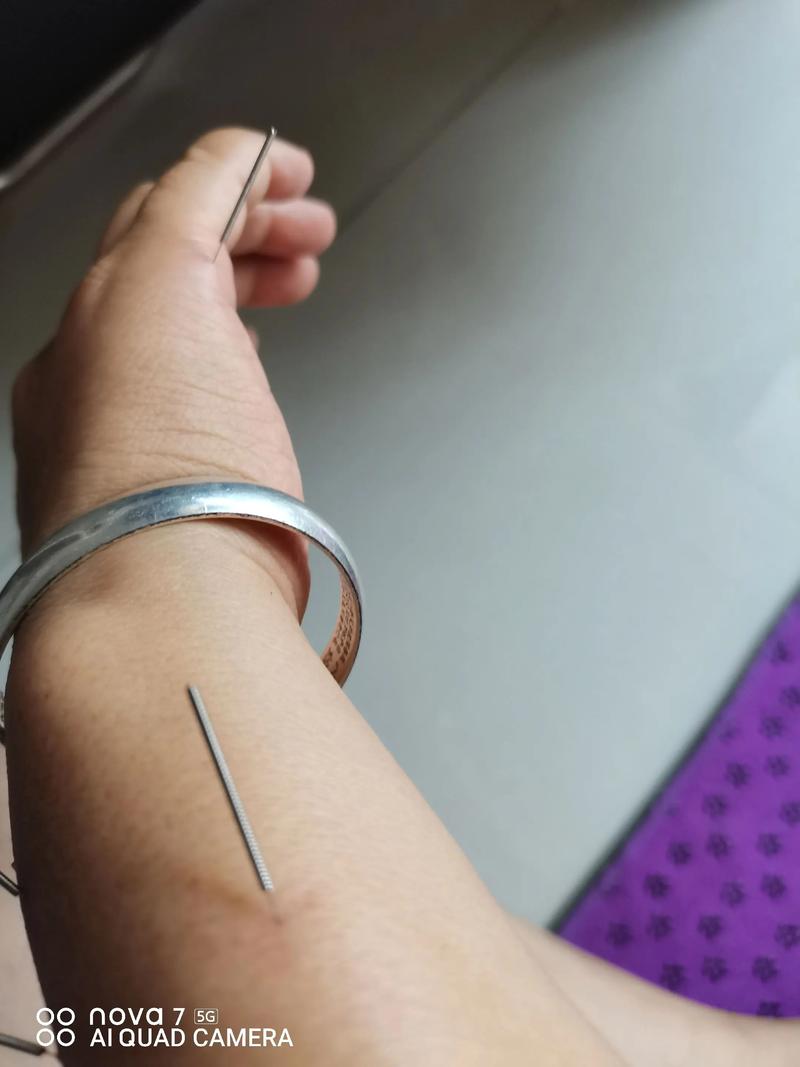 针灸治疗肩周炎的优势