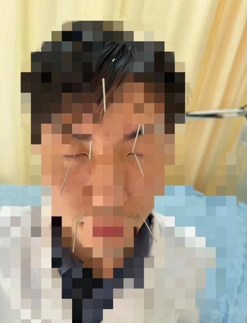 中日友好医院针灸鼻炎