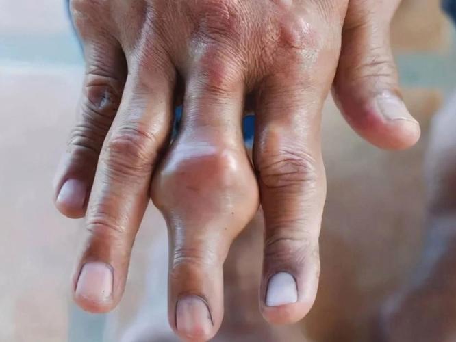 尿酸350 溶晶痛风