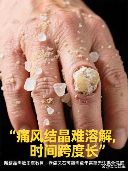 尿酸350 溶晶痛风