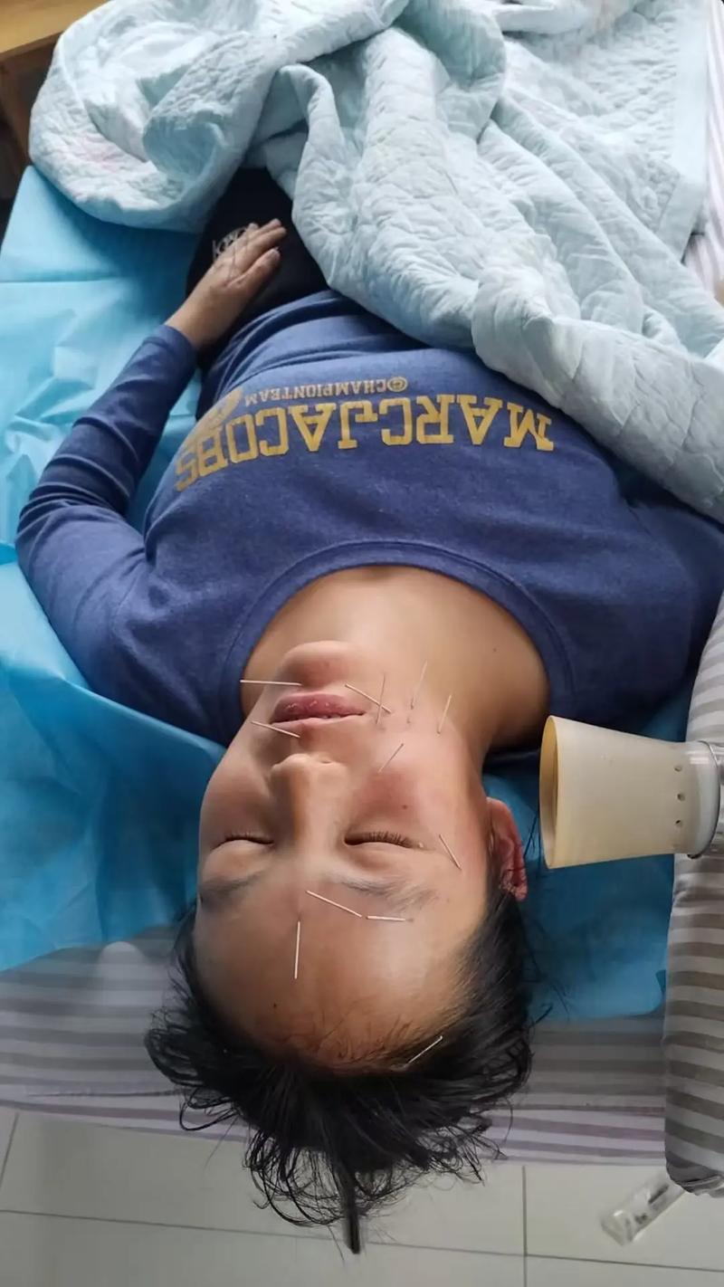 面瘫针灸扎到什么程度