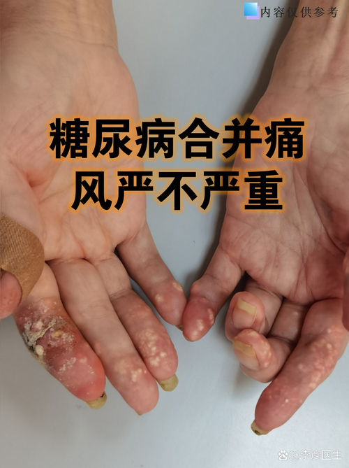 2026东方痛风论坛