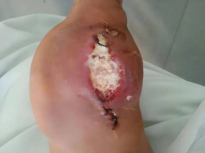 痛风第一次就有痛风石