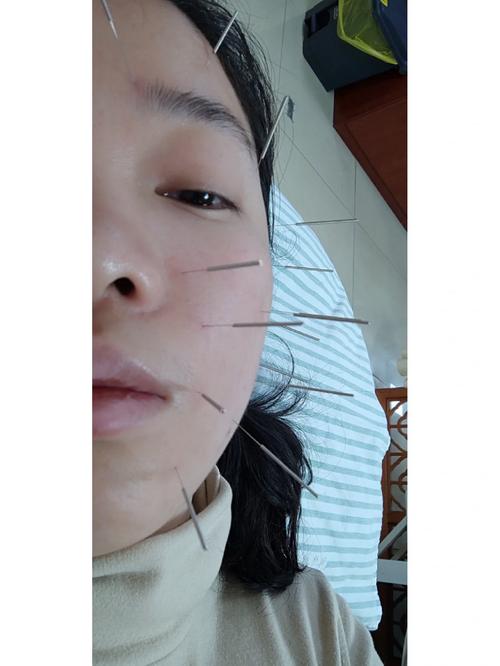 面瘫针灸三个月也没好