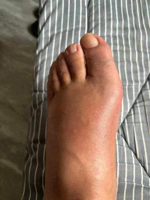 痛风大脚趾关节痛风石