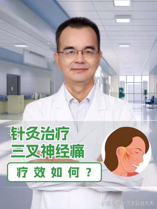 三叉神经痛可以针灸吗