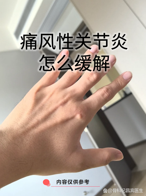 王氏痛风治疗痛风咋样