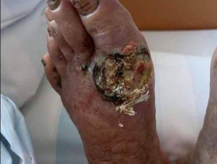 痛风多久才会有痛风石