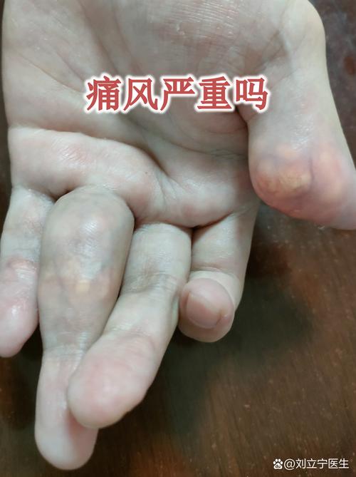 痛风一个月内反复发作