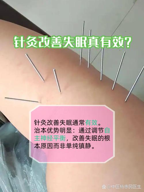 针灸失眠一般多长时间