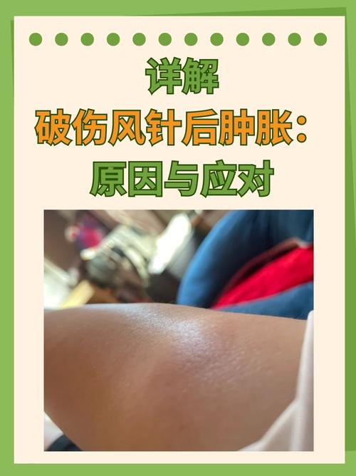 针灸扎完后肿了怎么办