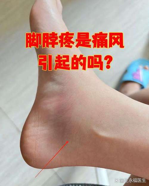 脚不红不肿疼是痛风吗