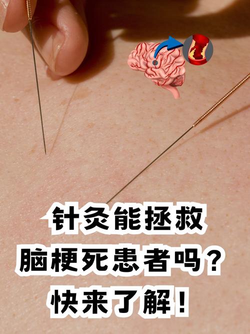 针灸对腔隙脑梗有用吗