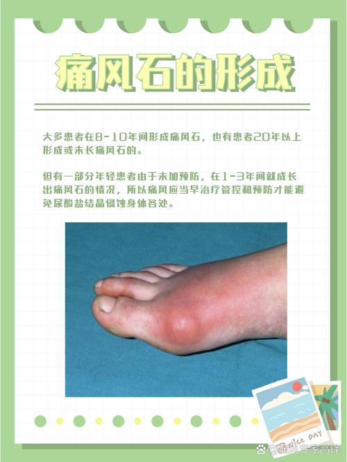 有痛风石了怎么排出来