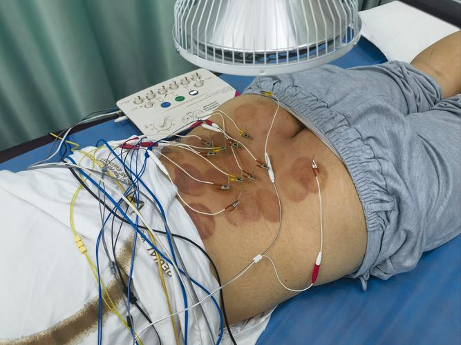 腰间盘膨出针灸有用吗