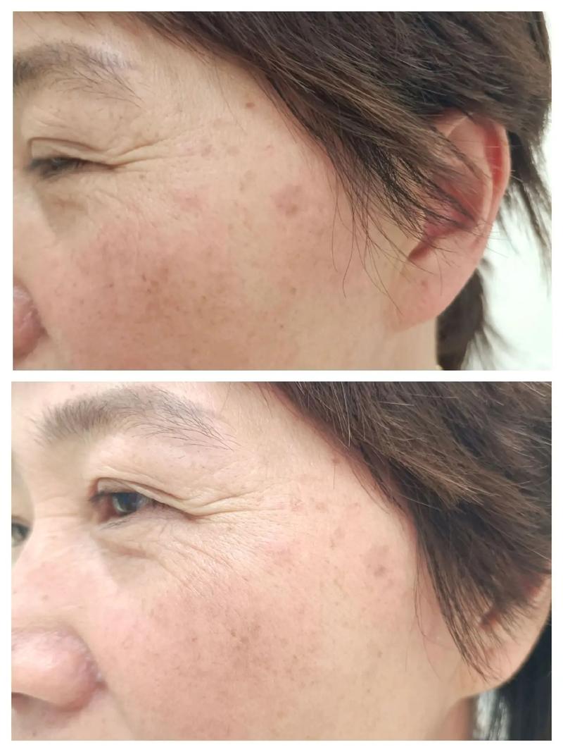 针灸祛斑多长时间能掉