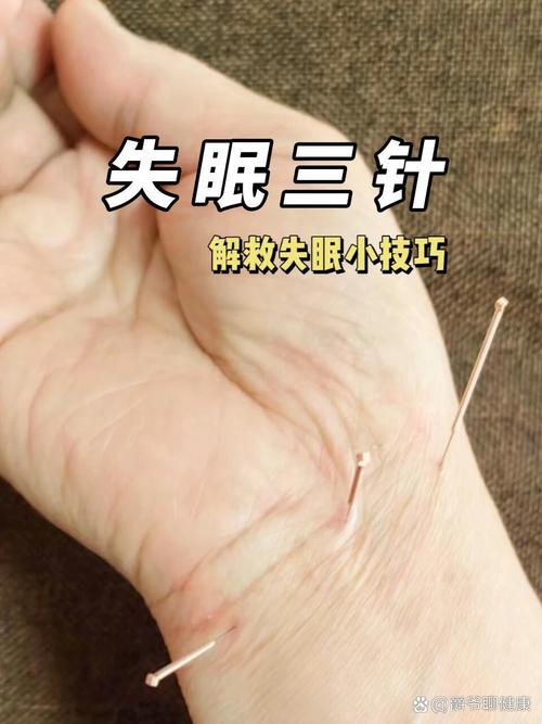 针灸治失眠一次多少钱