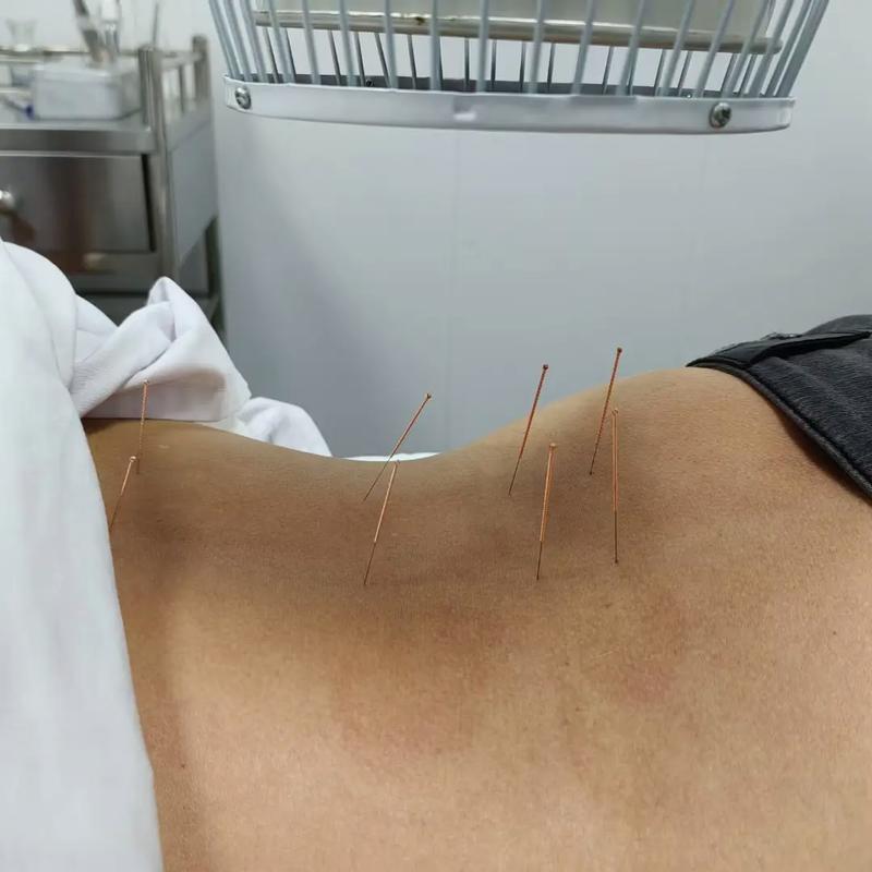 针灸治好了腰间盘突出