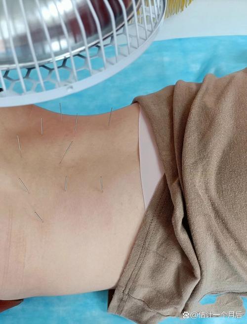 针灸治好了腰间盘突出