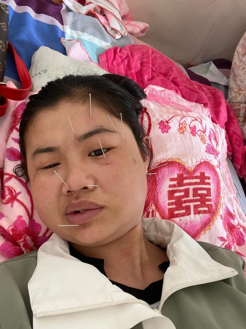 面神经炎针灸多久能好