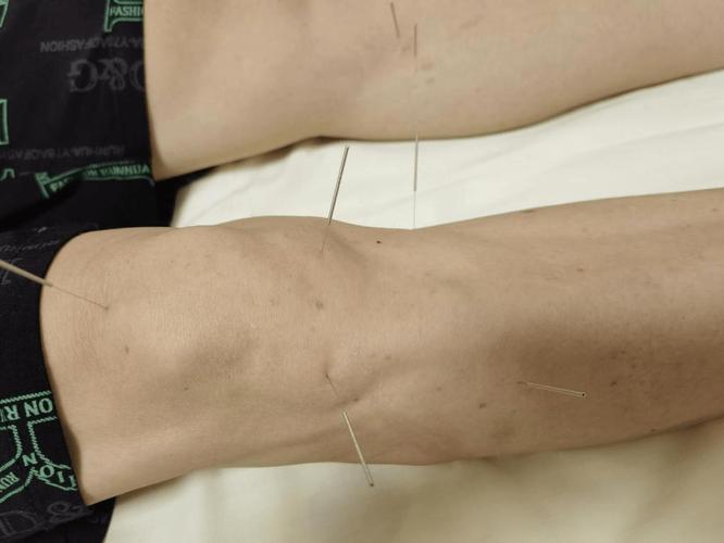 类风湿关节炎针灸管用